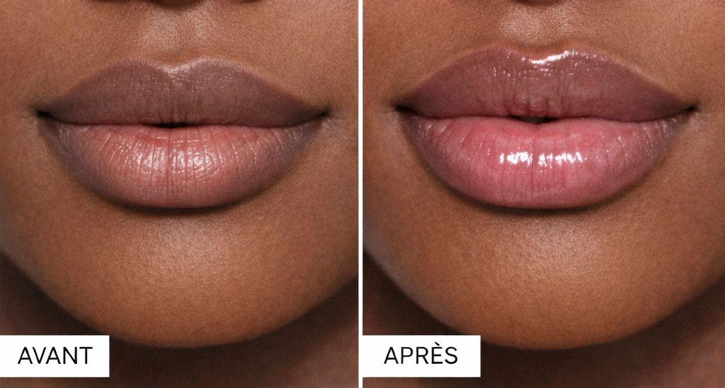 Lip Filler (0.5ML)