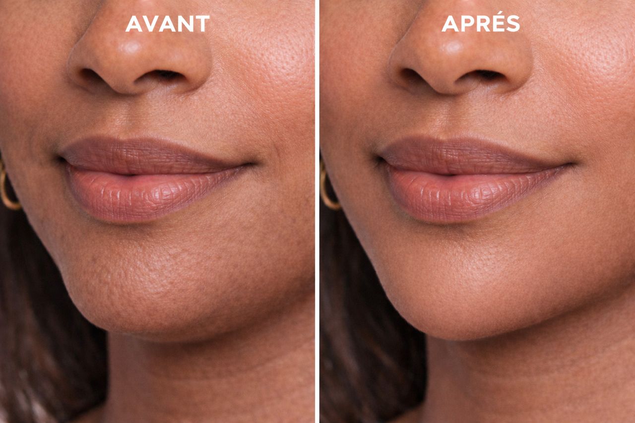 Chin Filler